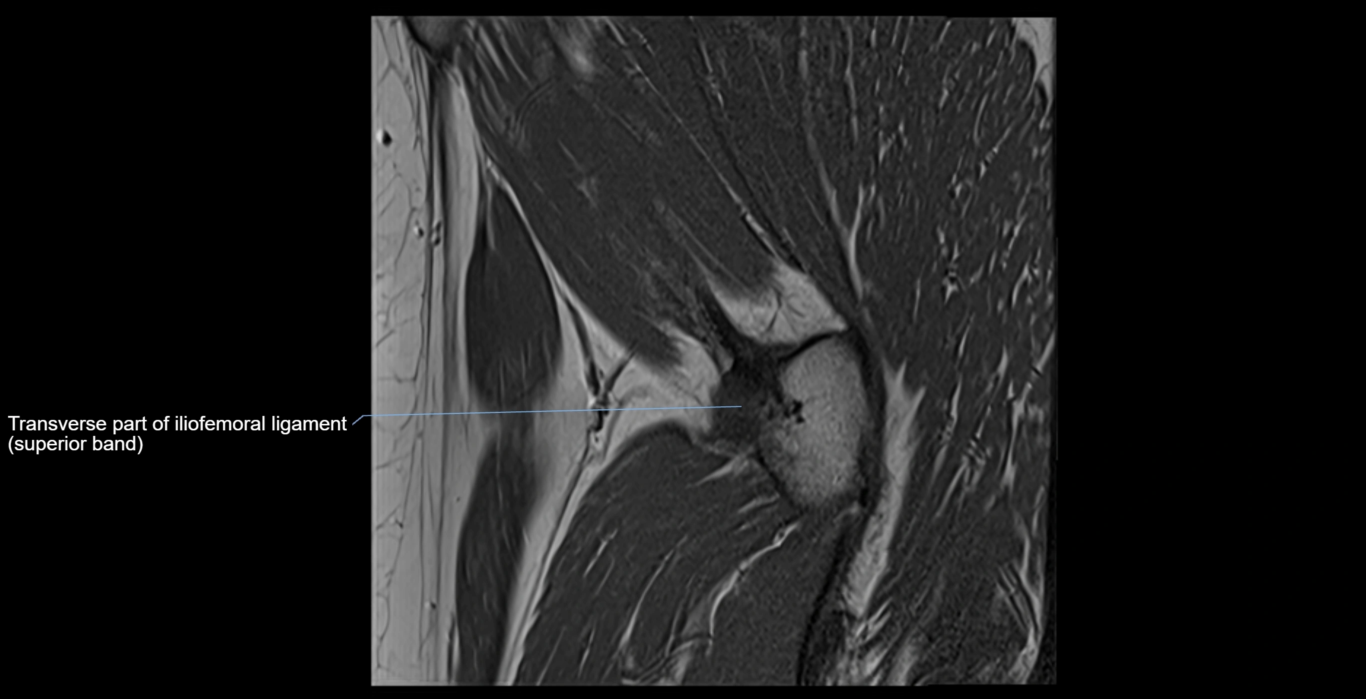 MRI Hip ligaments sagittal cross sectional anatomy 3T  radiology  image-img-00001-00024.webp